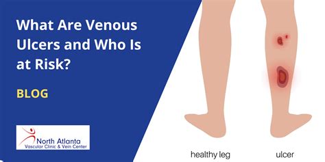 Venous Ulcer