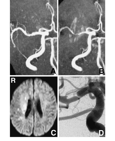 A B Magnetic Resonance MR Angiograms Obtained On Days 7 And 19