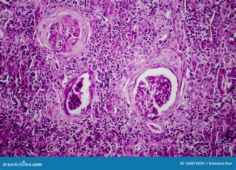 Chronic Glomerulonephritis Light Micrograph Stock Image Image Of