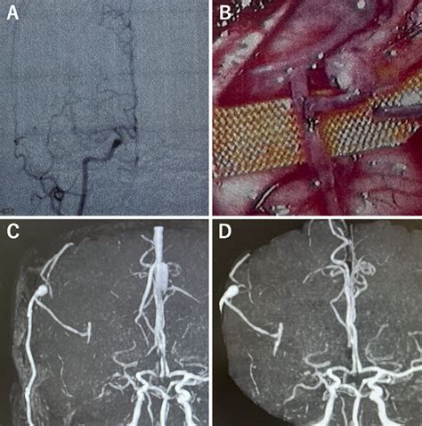 Superficial Temporal Artery Middle Cerebral Artery Sta Mca Bypass