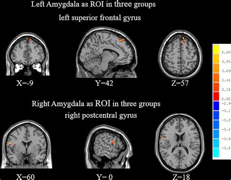 Frontiers Abnormal Functional Connectivity Between The Left Medial