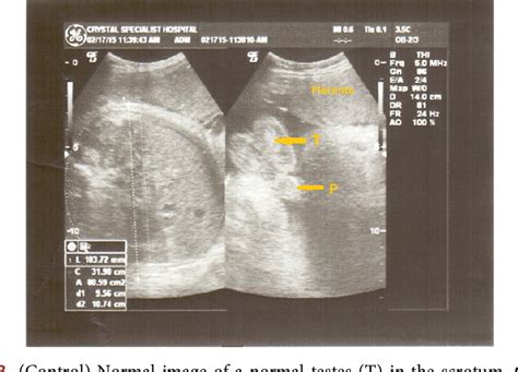 Fetal Hydrocele Ultrasound