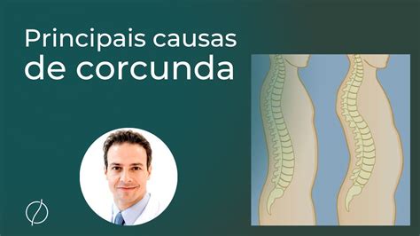 Principais causas de corcunda Especialista cirurgião de coluna