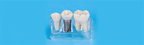 Choosing The Right Dentist For Your Tooth Crown Procedure