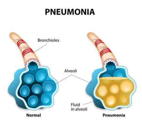 Pneumonia: Causes, Symptoms, and Treatment