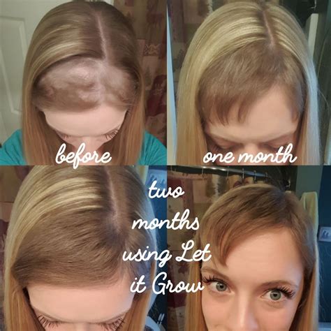 How To Control Hair Fall In Pcos Naturally Tips And Tricks Best