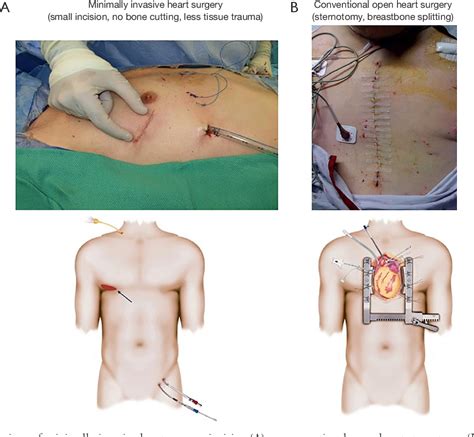 Figure 1 From Minimally Invasive Mitral Valve Surgery Tips Tricks And