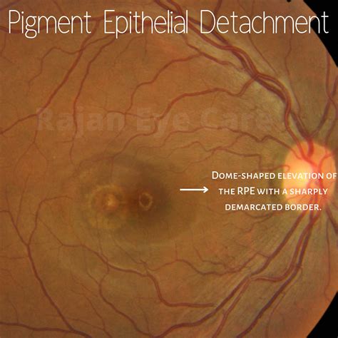 Serous Pigment Epithelial Detachment