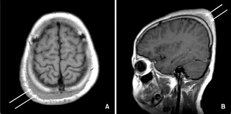 Radiologic Findings A The Mri Scan The Axial T Weighted Spin Echo