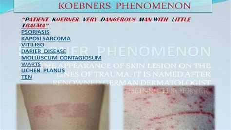 Koebner Phenomenon Mnemonic Dermatology Youtube