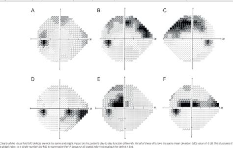 [PDF] Detecting Visual Field Progression in Glaucoma – Using the Right ...