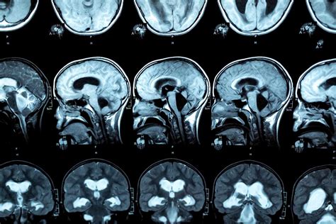 Hydrocephalus Types Symptoms Causes Diagnosis Treatment