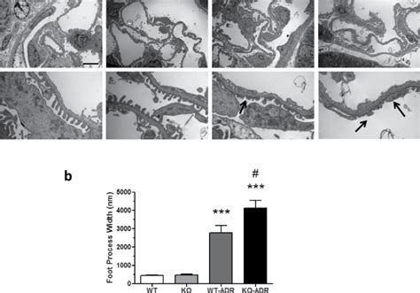 Increased Podocyte Foot Process Effacement In KO ADR Mice A