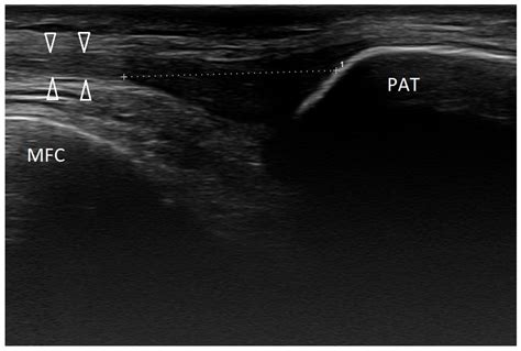 Ultrasound Of The Musculoskeletal System Springerlink