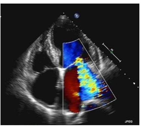 Echocardiogram Four Chamber Apical View With Colour Doppler Showing