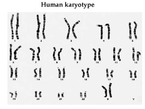 Chromosome Karyotype And Numerical Chromosomal Abnormalities Dr