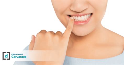 Qué es la gingivitis Descubre sus causas síntomas y cómo prevenirla