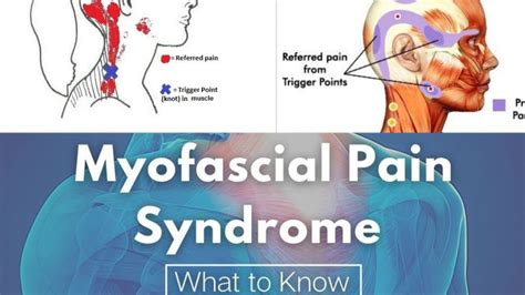 मांसपेशियों में दर्द Myofacial Pain Dysfunction Syndrome Mpdspart 1