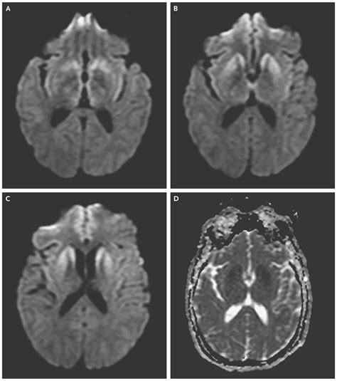 Variant CreutzfeldtJakob Disease In A Patient With Heterozygosity At