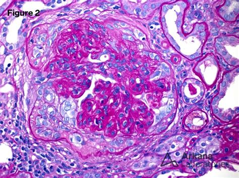 Proliferative Glomerulonephritis With Monoclonal Igg Deposits Pgmid