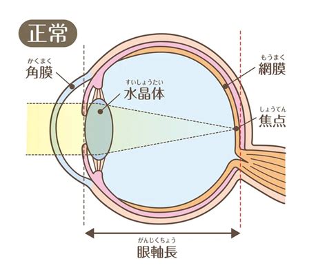 子どもの近視とは？原因と予防、治療法を解説 ヨクミテ｜医師監修の医療メディア