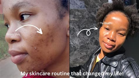 My Skincare Routine For Acne The Cleanser That Changed My Lifefinally