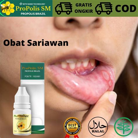 Jual Obat Herbal Mengatasi Sariawan Dan Panas Dalam Obat Sariawan