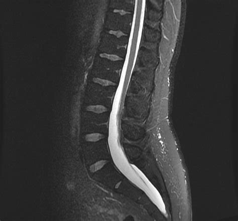 Tethered Cord Syndrome Image