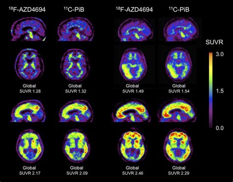 F Azd And C Pib Pet Imaging In Subjects Four Examples Of