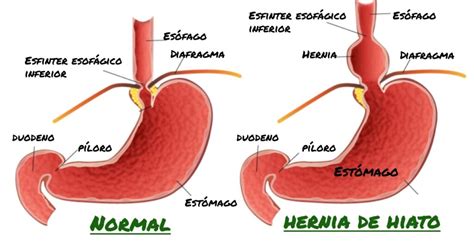 Hernia De Hiato Lo Que Deber As Saber Digestivo Saludable