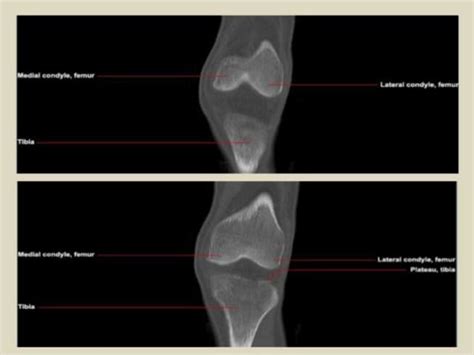 Presentation Pptx Radiological Anatomy Of The Knee Joint Ppt