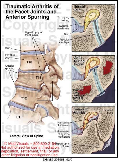 Traumatic Arthritis Of The Facet Joints And Anterior Spurring