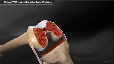 Arthrex Ibalance Tka Ligament Balancing Surgical Technique