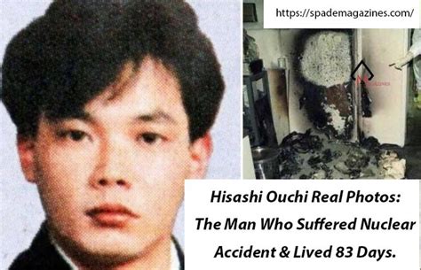 Hisashi Ouchi Real Photos: The Man Who Suffered Nuclear Accident & Lived 83 Days. Nuclear ...