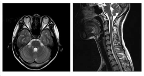 T2 Hyperintense Lesions In The Dorsal Medulla Oblongata And Right