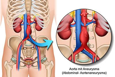 Aorta Abdominalis Aufbau Funktion Krankheiten MedLexi De