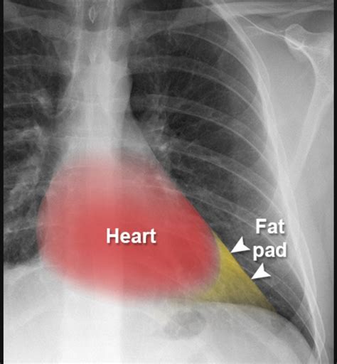 Sthanu On Twitter Pericardial Fat Pad The Heart Size Is Normal In