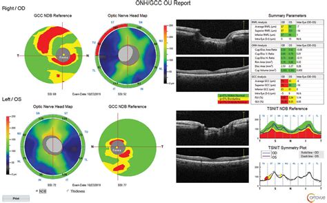 How Do OCT Devices For Glaucoma Compare