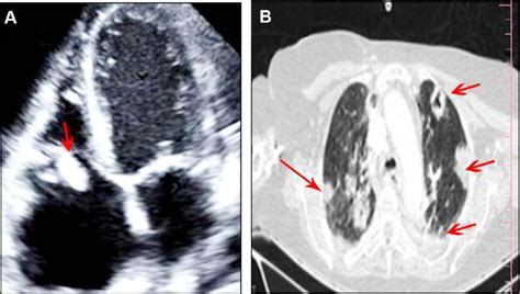 A 2d Transthoracic Echo Apical 4 Chamber Showing Large Vegetation On Download Scientific