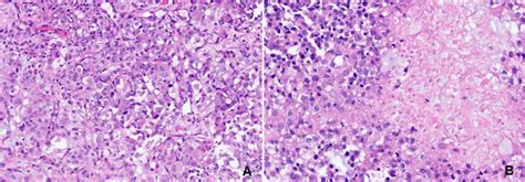 Histopathological Features Of Cic Rearranged Sarcoma A Cic Rearranged