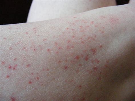 red splotches on lower legs - pictures, photos