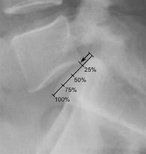 What is Anterolisthesis Symptoms, Grades and Its Treatment