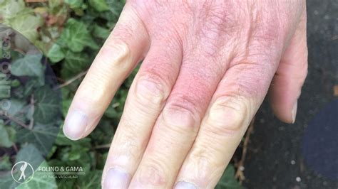 Como identificar a Síndrome de Raynaud e como é feito o tratamento