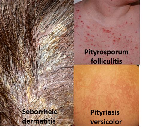 Pityrosporum Folliculitis Scalp