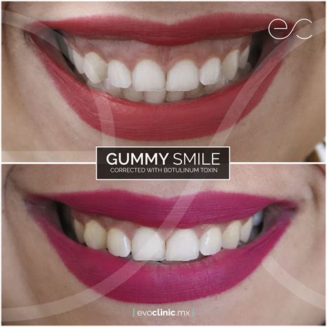 Gummy Smiles Cosmetic Surgery Gummy Smile Esthetics