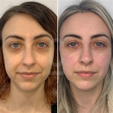 Under Eye Filler Cosmetic Connection