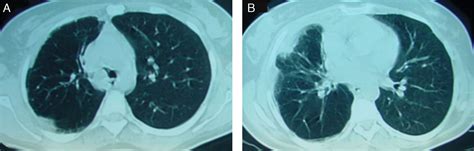 Primary Endobronchial Leiomyoma Endoscopic Laser Resection Pulmonology