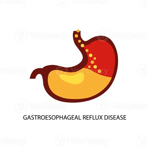 Gastroesophageal Reflux Disease Stomach Gerd Heartburn Esophagus Medical Illustration 32041949 Png