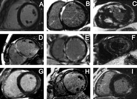 Cardiac Mri Evaluation Of Myocardial Disease Heart