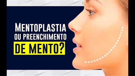 MENTOPLASTIA Ou PREENCHIMENTO De Mento Dr Vitor Erlacher YouTube